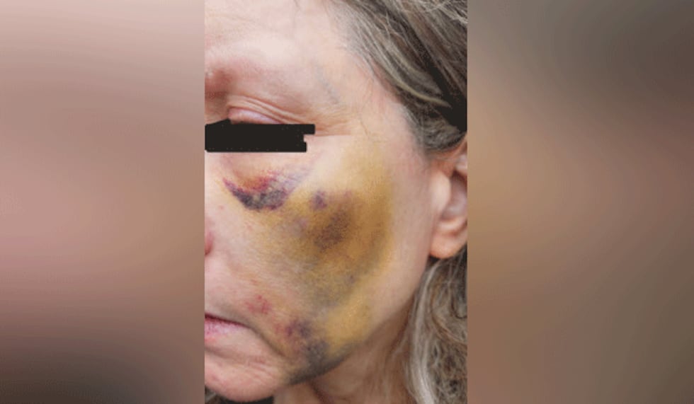 Amy Bunnell tras ser golpeada por Kirby Rankin el 4 de enero de este año. Su esposo, Lance...